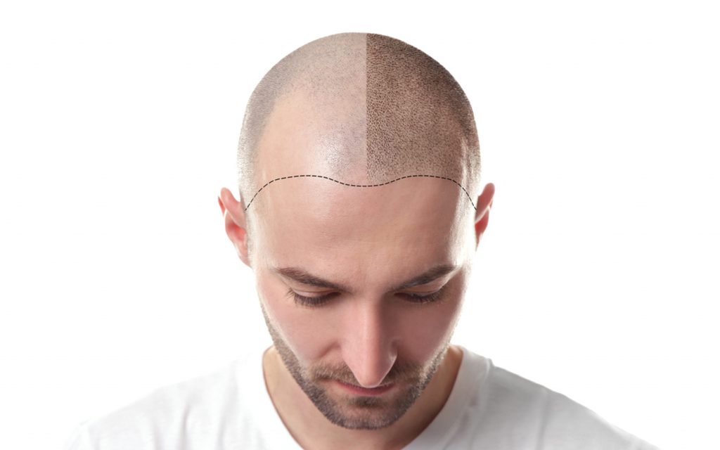 microneedling to repair scalp hyper-pigmentation